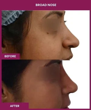 3 BROAD NOSE (5)_8_