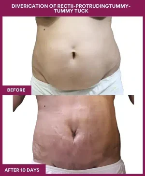 3 DIVERICATION OF RECTII-PROTRUDINGTUMMY- TUMMY TUCK (4)_7_