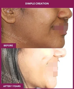 Dimple Creation Surgery in Mumbai, India