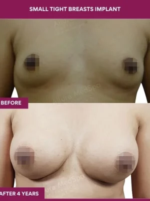 3 Small Tight Breasts Implant_9 (1)