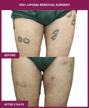 4 100+ Lipoma Removal Surgery