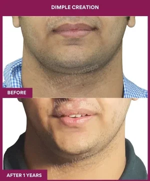 Male Dimple Creation Surgery in Mumbai, India