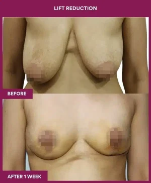4 Lift reduction