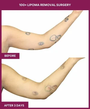 5 100+ Lipoma Removal Surgery (2)