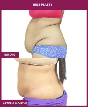 5 BELT PLASTY_15_ (3)