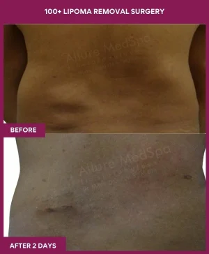 9 100+ Lipoma Removal Surgery (2)