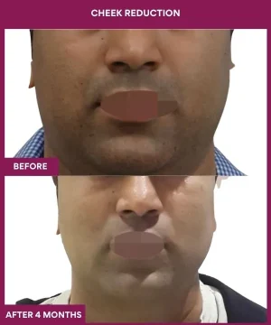 9 Cheek Reduction_27_