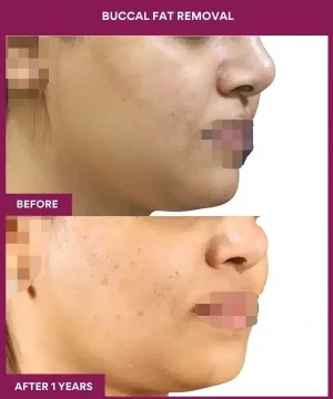 BUCCAL FAT REMOVAL in Mumbai, India