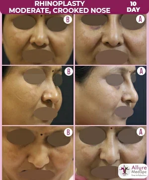 Rhinoplasty_Moderate_Crooked_Nose