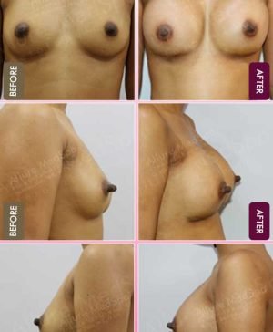 Submuscular-Breast-Implant-Before-After-photos-mumbai-india