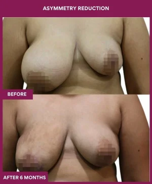 breast-asymmetry-reduction-before-after-results-mumbai-india-patient01-front