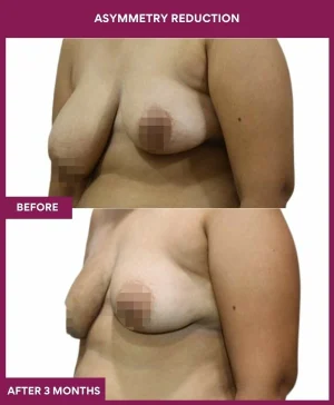 breast-asymmetry-reduction-before-after-results-mumbai-india-patient01-side-left