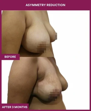 breast-asymmetry-reduction-before-after-results-mumbai-india-patient01-side-right