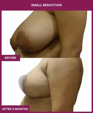 breast-asymmetry-reduction-before-after-results-mumbai-india-patient04-side-left