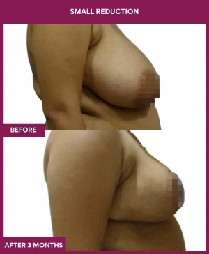 breast-asymmetry-reduction-before-after-results-mumbai-india-patient04-side-right