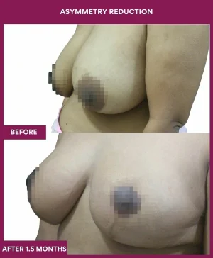 breast-asymmetry-reduction-before-after-results-mumbai-india-patient05-side-left