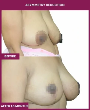 breast-asymmetry-reduction-before-after-results-mumbai-india-patient05-side-right