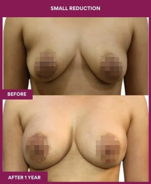 breast-asymmetry-reduction-before-after-results-mumbai-india-patient06-front