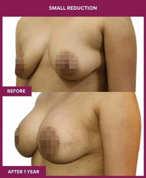 breast-asymmetry-reduction-before-after-results-mumbai-india-patient06-left-side