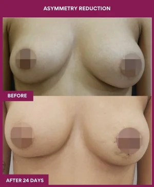 breast-asymmetry-reduction-before-after-results-mumbai-india-patient07-front