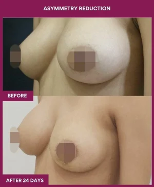 breast-asymmetry-reduction-before-after-results-mumbai-india-patient07-side-left
