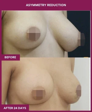 breast-asymmetry-reduction-before-after-results-mumbai-india-patient07-side-right