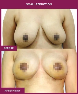 breast-asymmetry-reduction-before-after-results-mumbai-india-patient08-front
