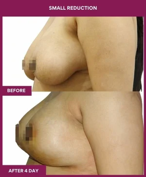 breast-asymmetry-reduction-before-after-results-mumbai-india-patient08-side-left