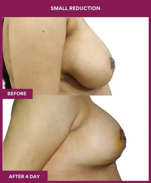 breast-asymmetry-reduction-before-after-results-mumbai-india-patient08-side-right
