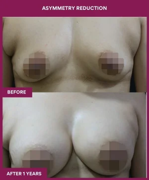 breast-asymmetry-reduction-before-after-results-mumbai-india-patient09-front