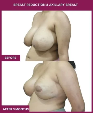 breast-reduction-axillary-breast-before-after-results-mumbai-india-patient01-side-left