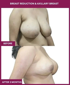 breast-reduction-axillary-breast-before-after-results-mumbai-india-patient01-side-right