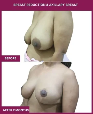 breast-reduction-axillary-breast-before-after-results-mumbai-india-patient02-side-left