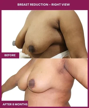 breast-reduction-surgery-before-after-results-mumbai-india-patient01-side-left