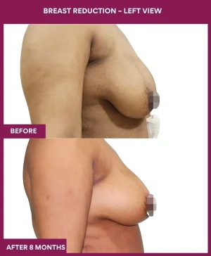 breast-reduction-surgery-before-after-results-mumbai-india-patient01-side-right
