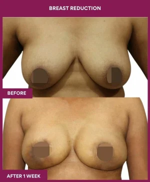 breast-reduction-surgery-before-after-results-mumbai-india-patient02-front