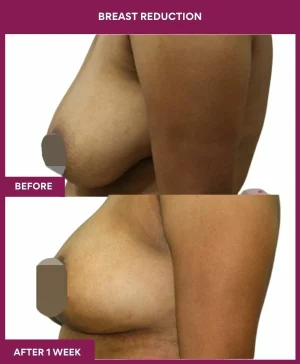 breast-reduction-surgery-before-after-results-mumbai-india-patient02-side-left