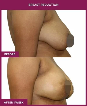 breast-reduction-surgery-before-after-results-mumbai-india-patient02-side-right
