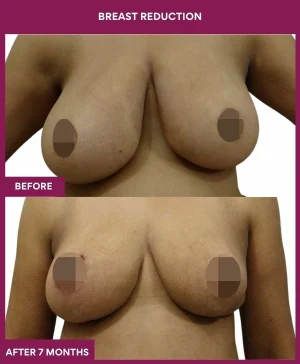 breast-reduction-surgery-before-after-results-mumbai-india-patient03-front