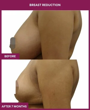 breast-reduction-surgery-before-after-results-mumbai-india-patient03-side-left