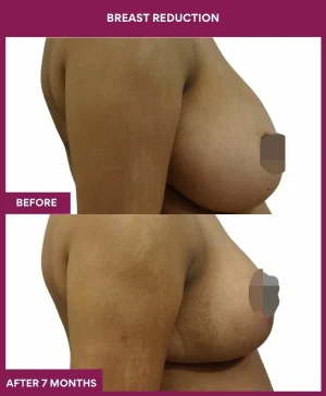 breast-reduction-surgery-before-after-results-mumbai-india-patient03-side-right