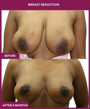 breast-reduction-surgery-before-after-results-mumbai-india-patient04-front