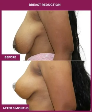breast-reduction-surgery-before-after-results-mumbai-india-patient04-side-left
