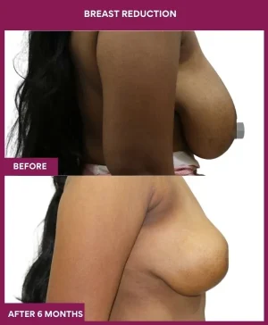 breast-reduction-surgery-before-after-results-mumbai-india-patient04-side-right