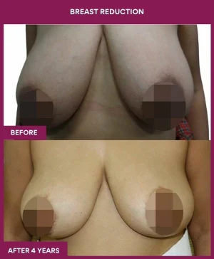 breast-reduction-surgery-before-after-results-mumbai-india-patient05-front