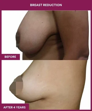 breast-reduction-surgery-before-after-results-mumbai-india-patient05-side-left