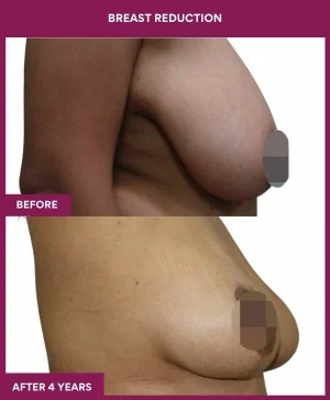 breast-reduction-surgery-before-after-results-mumbai-india-patient05-side-right