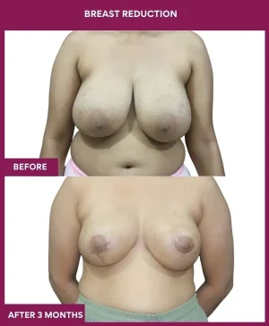 breast-reduction-surgery-before-after-results-mumbai-india-patient06-front