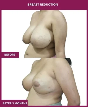 breast-reduction-surgery-before-after-results-mumbai-india-patient06-side-left