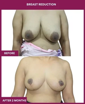 breast-reduction-surgery-before-after-results-mumbai-india-patient07-front